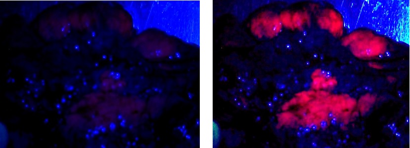 atypicalmeningioma3.jpg