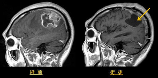glioma3.jpg
