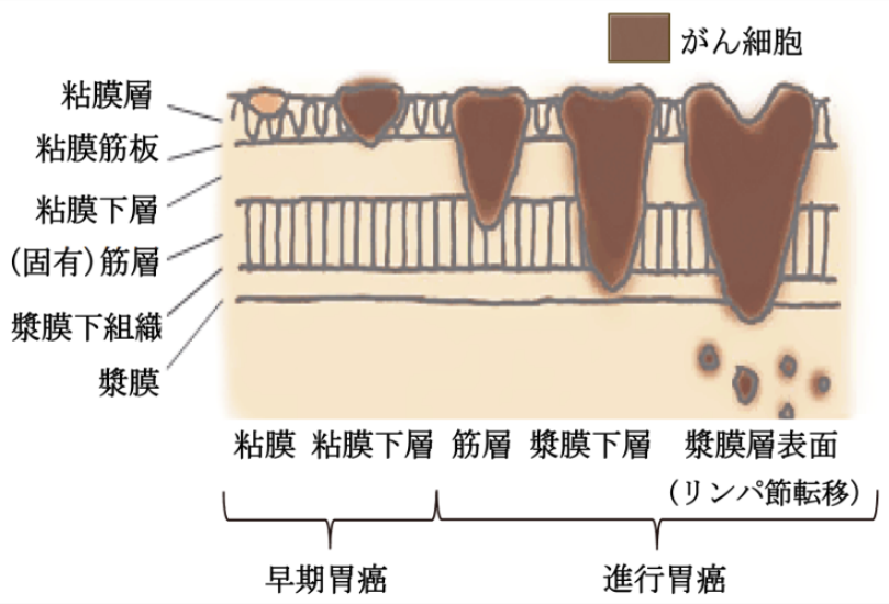 CPAP治療