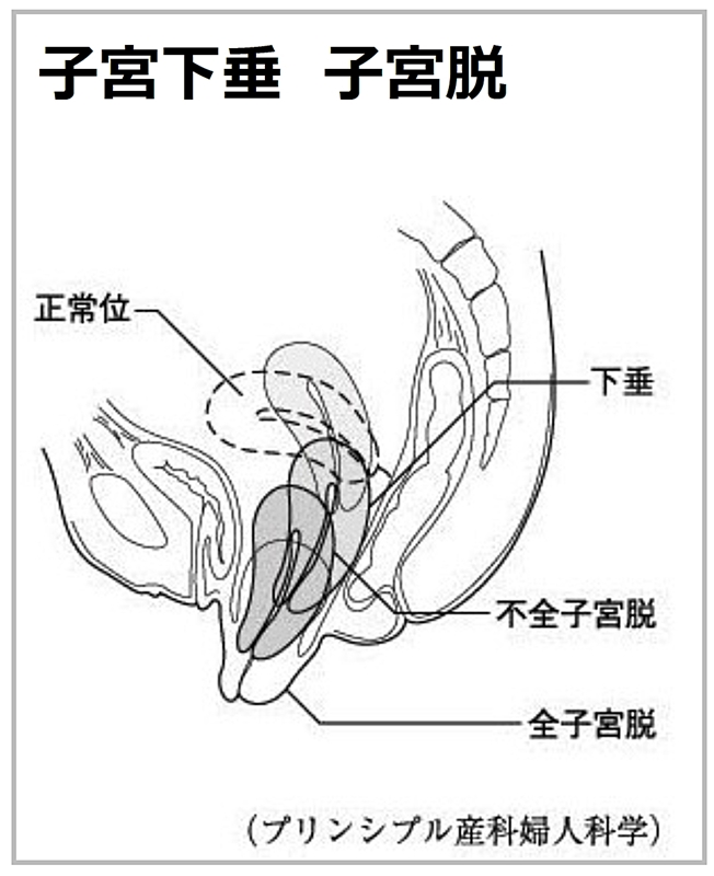 子宮下垂　子宮脱　図