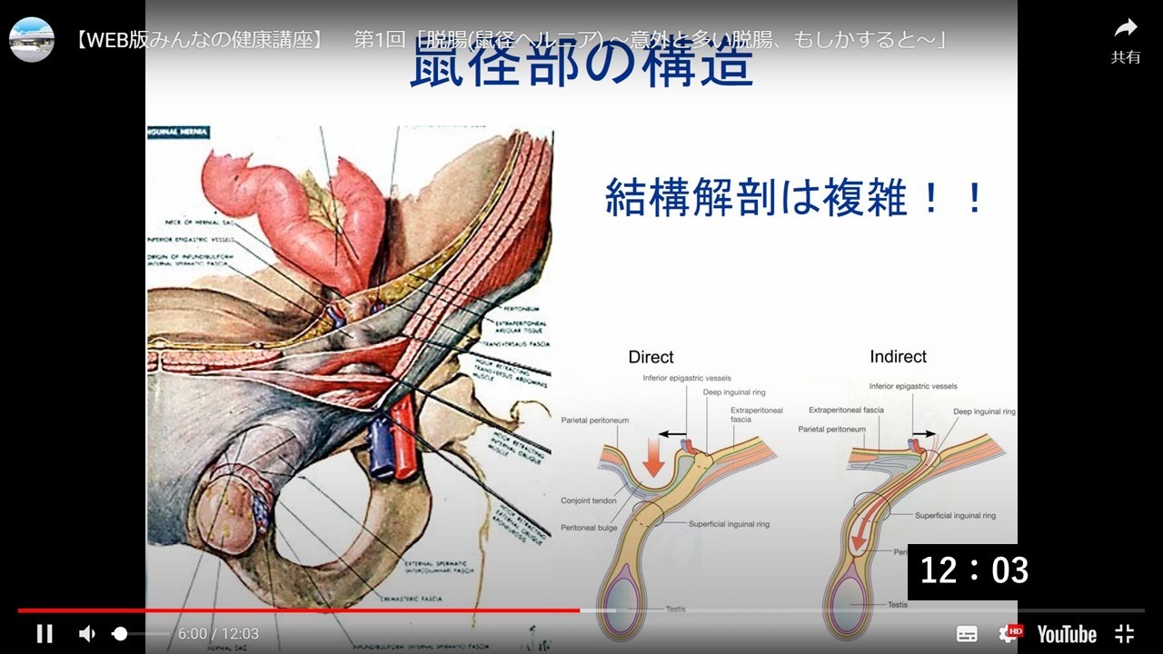 脱腸 ～意外と多い脱腸、もしかすると～