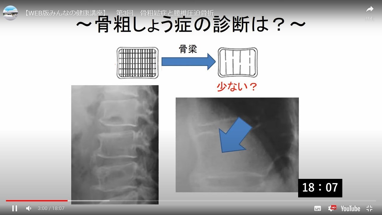 骨粗鬆症と腰椎圧迫骨折