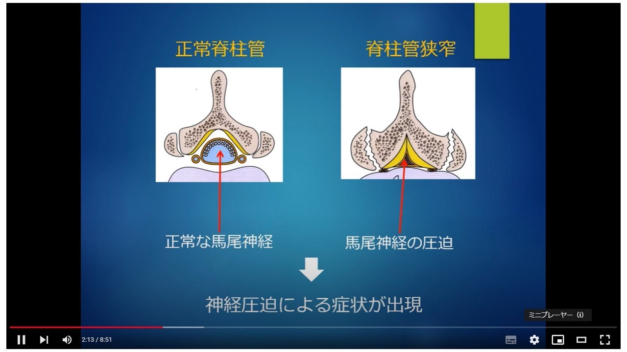 腰部脊柱管狭窄症の診断と治療法