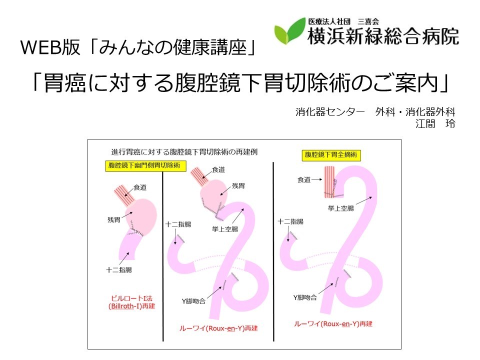 胃癌に対する腹腔鏡下胃切除術のご案内