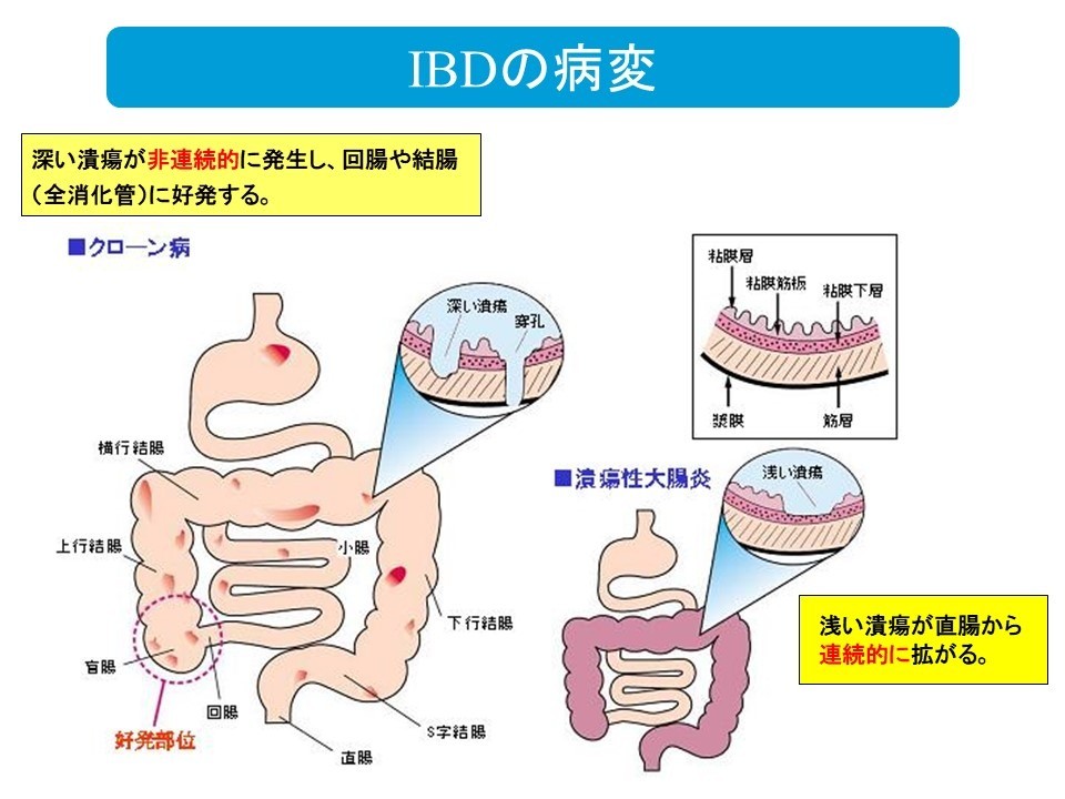 IBD（炎症性腸疾患）とは？～その病態と治療～